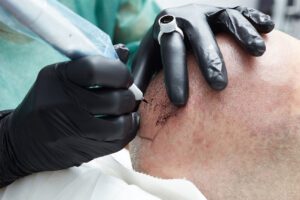 Scalp Micropigmentation