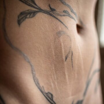 Stomach Tattoos That Cover Stretch Marks: What to Know